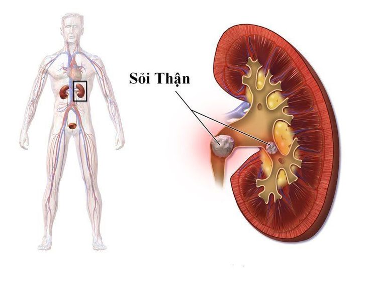 
Sỏi thận có thể ngăn nước tiểu ra khỏi cơ thể
