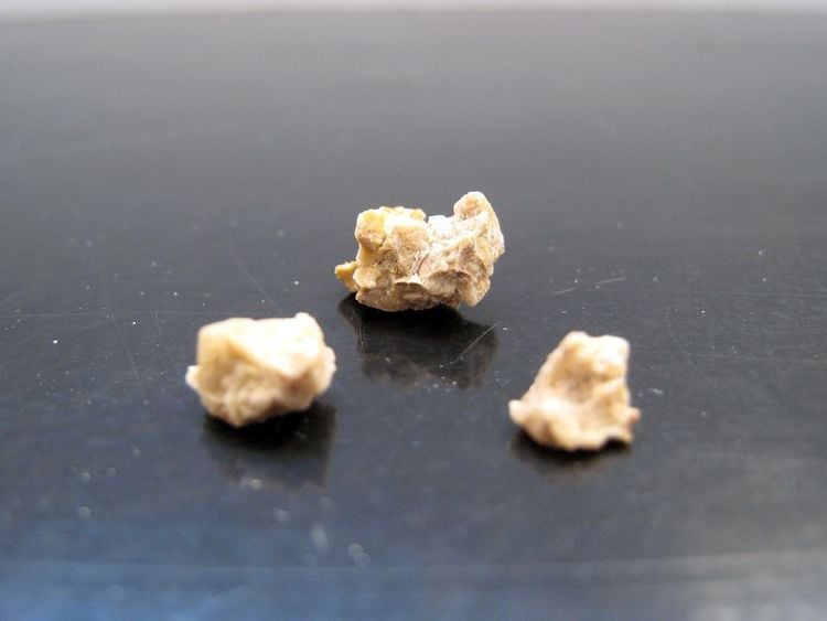 Kidney stones can lead to many severe health complications.