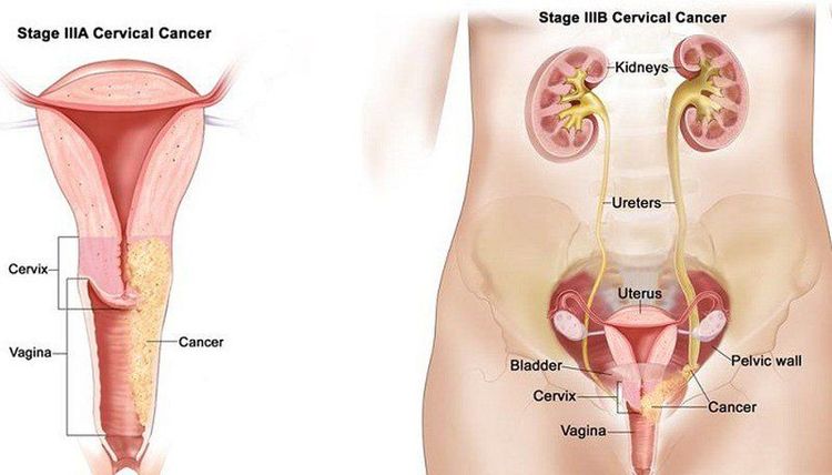 
Một số điều kiện làm tăng nguy cơ phát triển ung thư nội mạc tử cung của phụ nữ, như béo phì hoặc dùng estrogen mà không có progesterone
