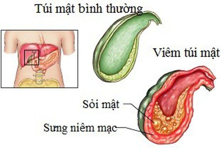 
Sỏi túi mật là nguyên nhân chính gây ra viêm túi mật.
