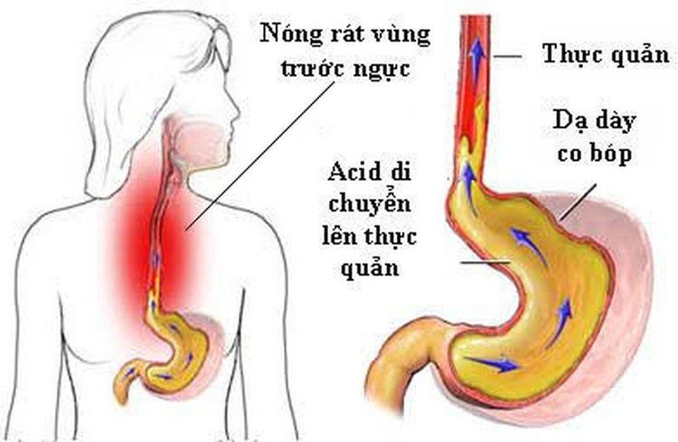 
Quá trình trào ngược họng – thanh quản
