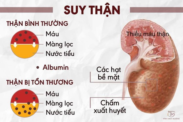 
Suy thận gây ảnh hưởng tới sức khỏe
