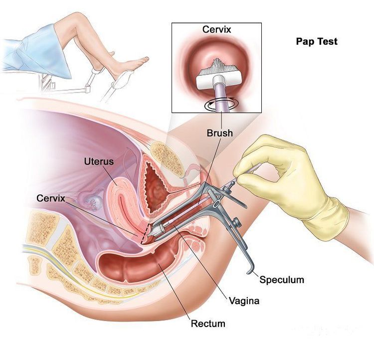 
Xét nghiệm Pap là xét nghiệm sàng lọc truyền thống
