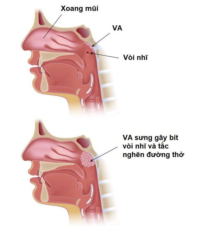 
Viêm VA khiến trẻ thở khó khăn hơn
