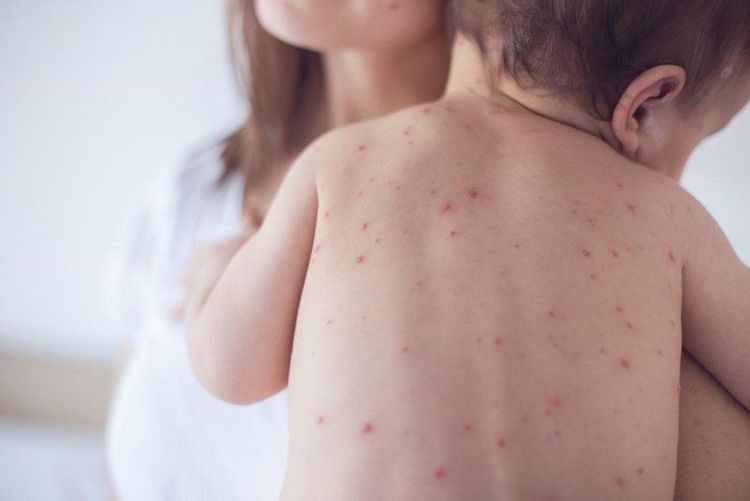 
Taking care of children with rashes properly will not leave bruises
