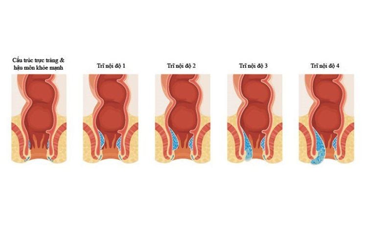 
Các mức độ sa niêm mạc.
