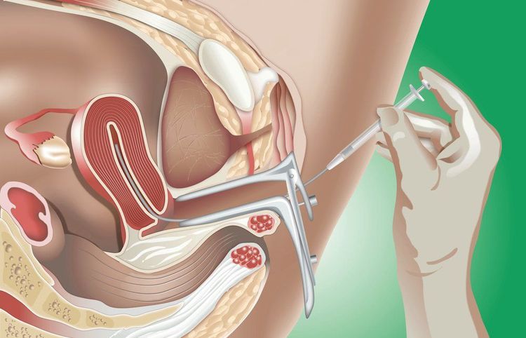 
Lọc rửa tinh trùng trước khi làm IUI
