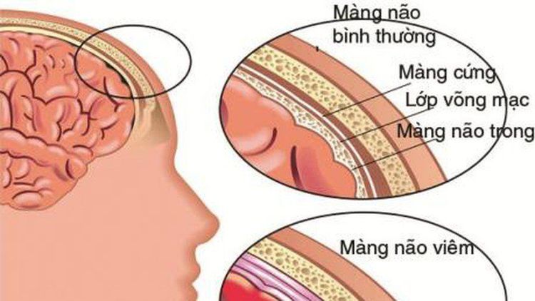 
Một khi vào bên trong hệ thống thần kinh, virus tạo ra chứng viêm não cấp tính
