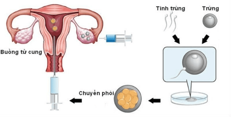 
Thực hiện chuyển phôi vào tử cung
