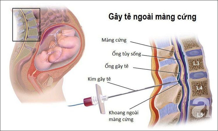 
Gây tê ngoài màng cứng áp dụng trên sản phụ khi sinh thường
