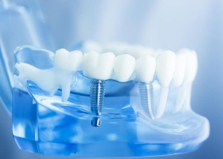 
Cấy ghép implant là giải pháp tối ưu cho người bị mất răng lâu năm
