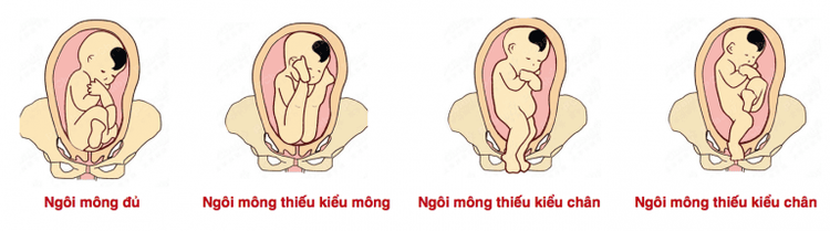 
Positions of breech presentation
