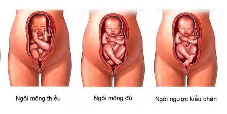 
Các loại ngôi thai ngược
