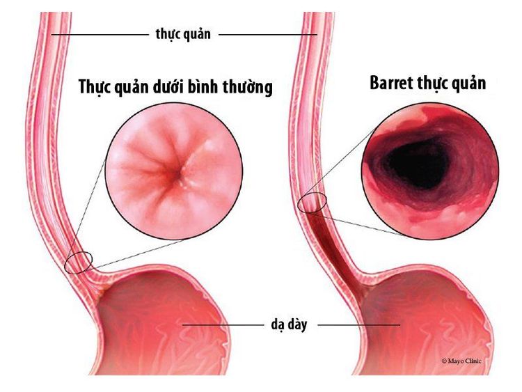 
Barrett thực quản là một trong những biến chứng của trào ngược dạ dày
