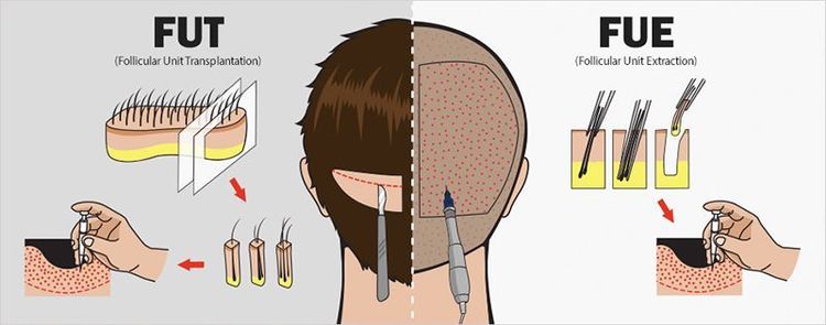 
Hình 2: 2 kỹ thuật cấy tóc FUT và FUE
