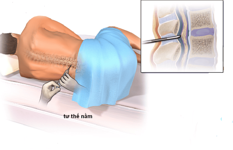 
Việc xét nghiệm dịch não tủy sẽ định hướng cũng như giúp các bác sĩ lâm sàng có những chẩn đoán xác định
