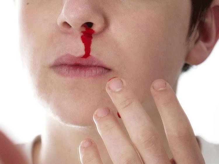 
Patients with frequent nosebleeds need an ENT endoscopy to help find the cause of the disease
