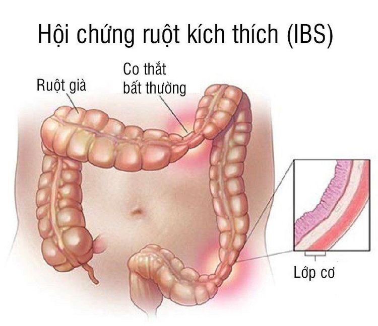 
Người bị hội chứng IBS còn kèm theo các triệu chứng tiêu chảy hoặc táo bón, đau bụng
