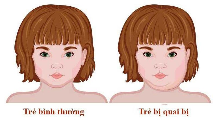 
Trẻ bị quai bị
