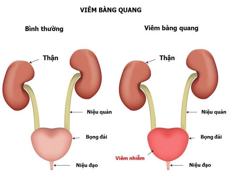 
Viêm đường tiết niệu
