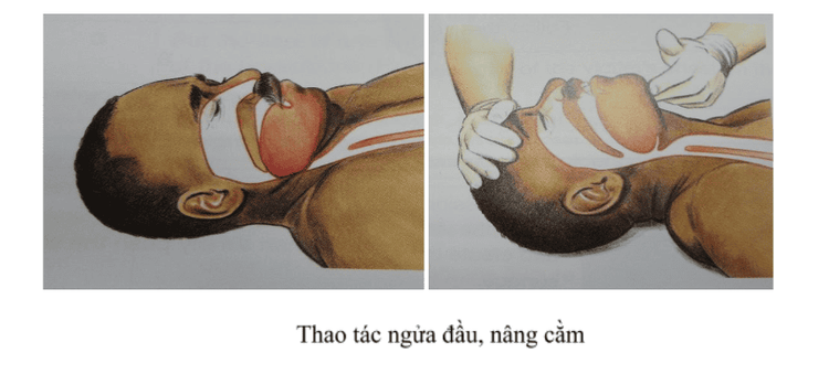 
Ngửa đầu bệnh nhân ra sau và đẩy hàm dưới nâng cằm lên
