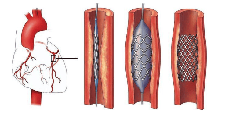 
Can thiệp đặt stent mạch vành
