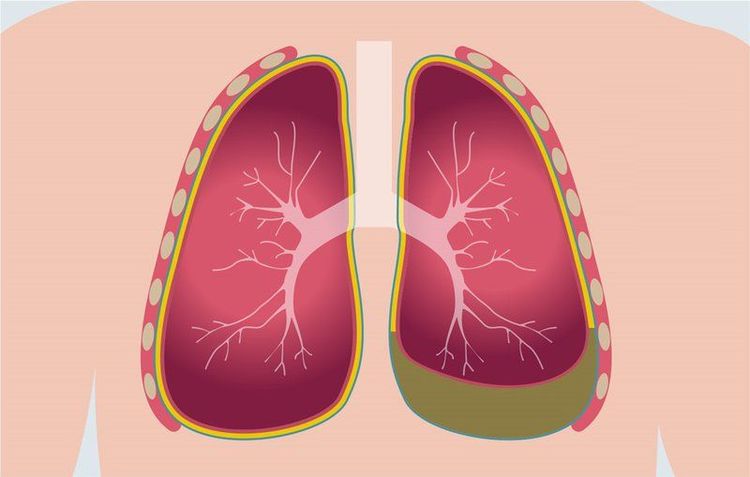 
Bệnh nhân bị tràn dịch màng phổi
