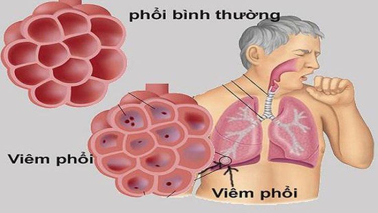 
Viêm phổi: tổn thương tổ chức phổi do tình trạng viêm nhiễm phế nang, thường do nhiễm khuẩn
