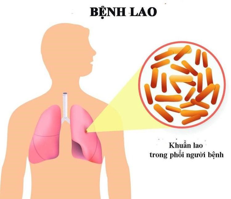 
Bệnh lao phổi là nguyên nhân hàng đầu gây tử vong ở những người bị AIDS
