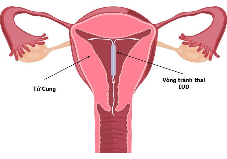 
Đặt vòng tránh thai
