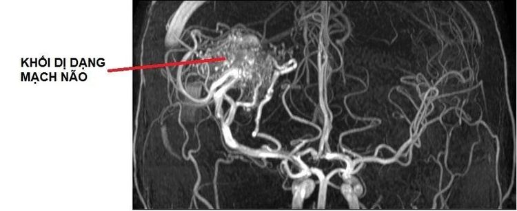 
Chụp cộng hưởng từ MRI chẩn đoán bệnh dị dạng mạch máu não
