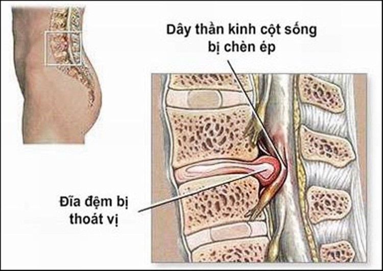 Khi thoát vị đĩa đệm cột sống thắt lưng có chèn ép vào rễ dây thần kinh tọa (thần kinh hông) sẽ dẫn đến chứng đau thắt lưng và đau lan xuống chân. 