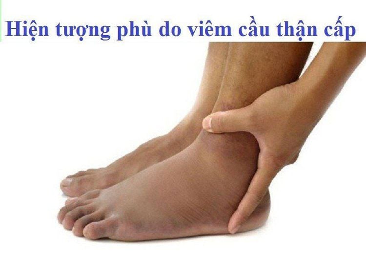 
Phù do viêm cầu thận
