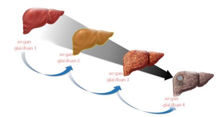 Độ xơ hóa gan F0-1 là gì? Chẩn đoán và phương pháp điều trị hiệu quả