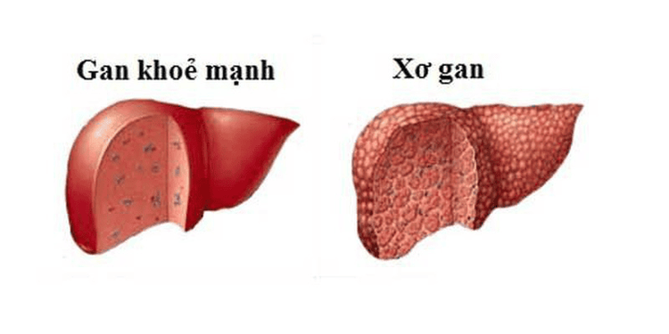 
Suy gan do viêm gan C
