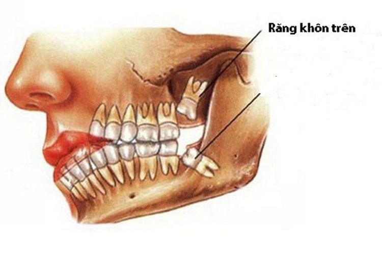 
Răng khôn mọc lệch hàm trên
