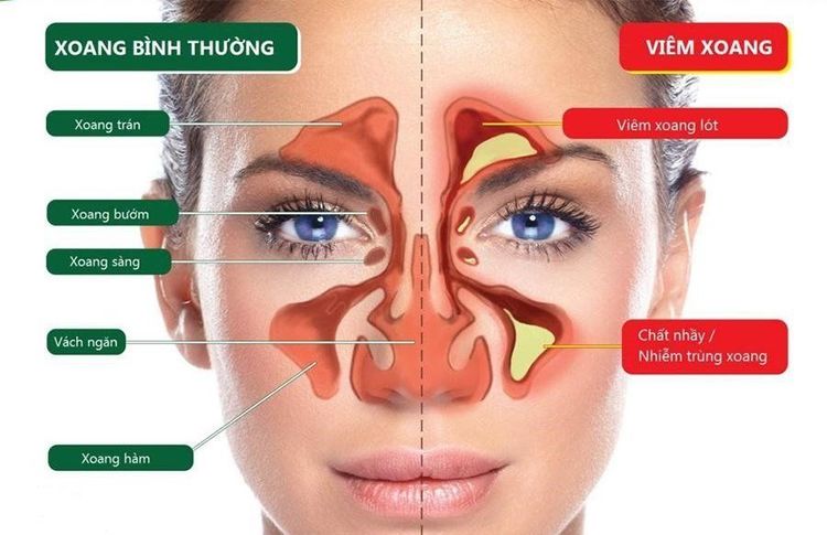 
Viêm xoang thường gây đau nửa đầu thường đau ở vị trí của các xoang
