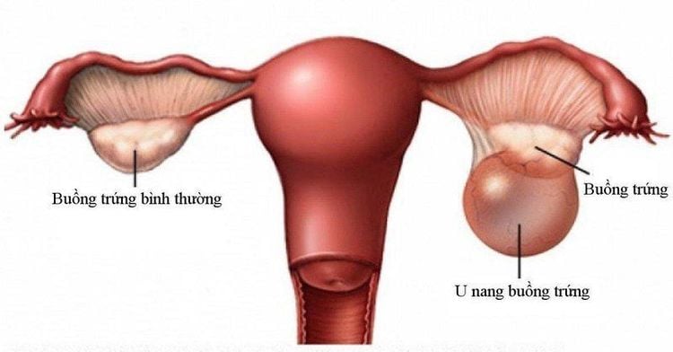 Không phải mọi u nang đều tác động đến khả năng sinh sản.