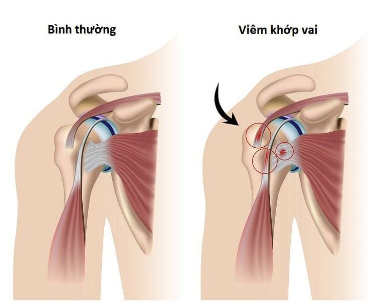 Bệnh viêm khớp vai gây ảnh hưởng nghiêm trọng tới sức khỏe và cuộc sống của bệnh nhân 