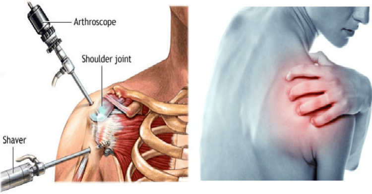 
Phẫu thuật nội soi khớp vai được chỉ định cho các trường hợp mắc bệnh ở khớp vai
