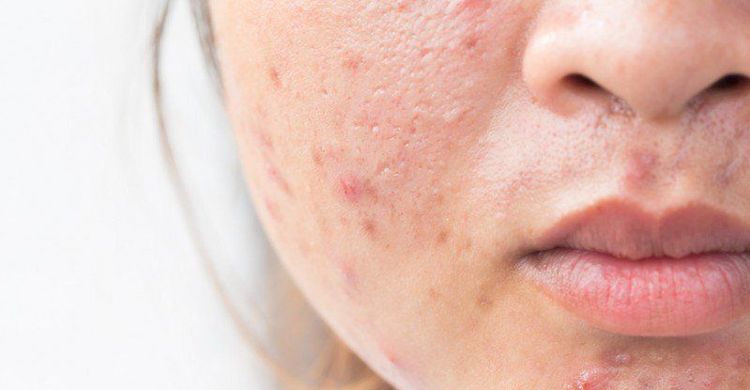 
Facial skin becomes oily and acne prone
