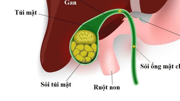 
Biến chứng sỏi ống mật chủ
