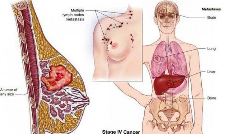 
Tế bào ung thư xâm lấn (ác tính) và di căn đến các cơ quan khác
