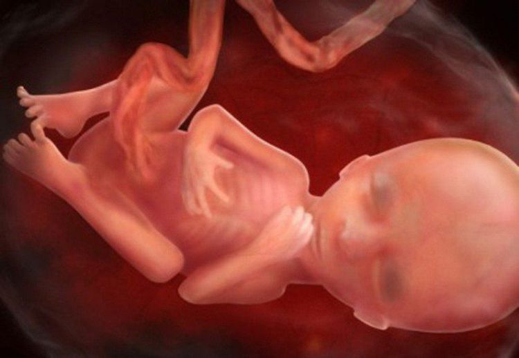 
Lack of nutrition for the fetus leads to stillbirth
