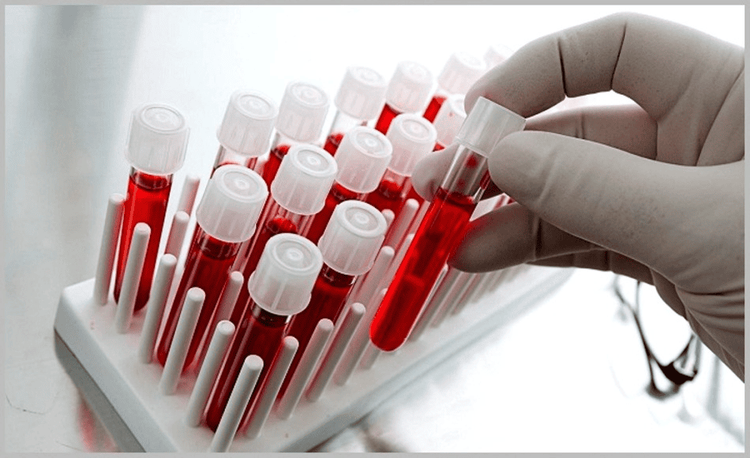 
Test blood coagulation function before choosing a method to deliver the stillbirth
