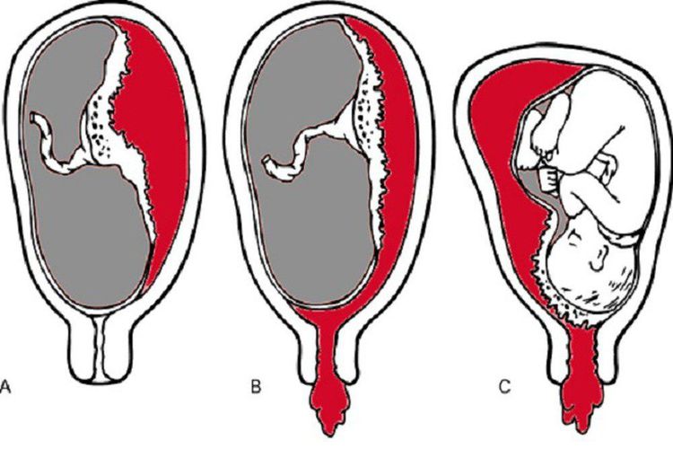 
Rau tiền đạo bám thấp là một trong các loại rau tiền đạo thường gặp ở bà bầu
