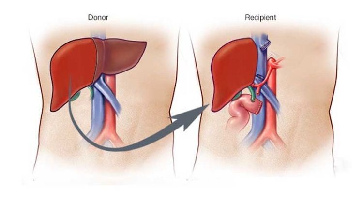 
Trẻ nhỏ có thế được chỉ định cấy ghép gan khi cần thiết
