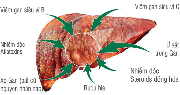 
Một số nguyên nhân dẫn tới ung thư gan
