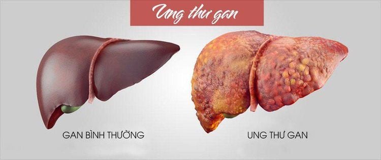 
Bệnh ung thư gan có thể được phòng chống bằng cách tiêm chủng vắc-xin viêm gan B
