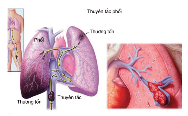 
Thuyên tắc mạch phổi là tình trạng tắc nghẽn của phổi
